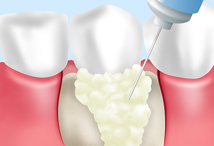 歯周組織再生治療（エムドゲイン法）